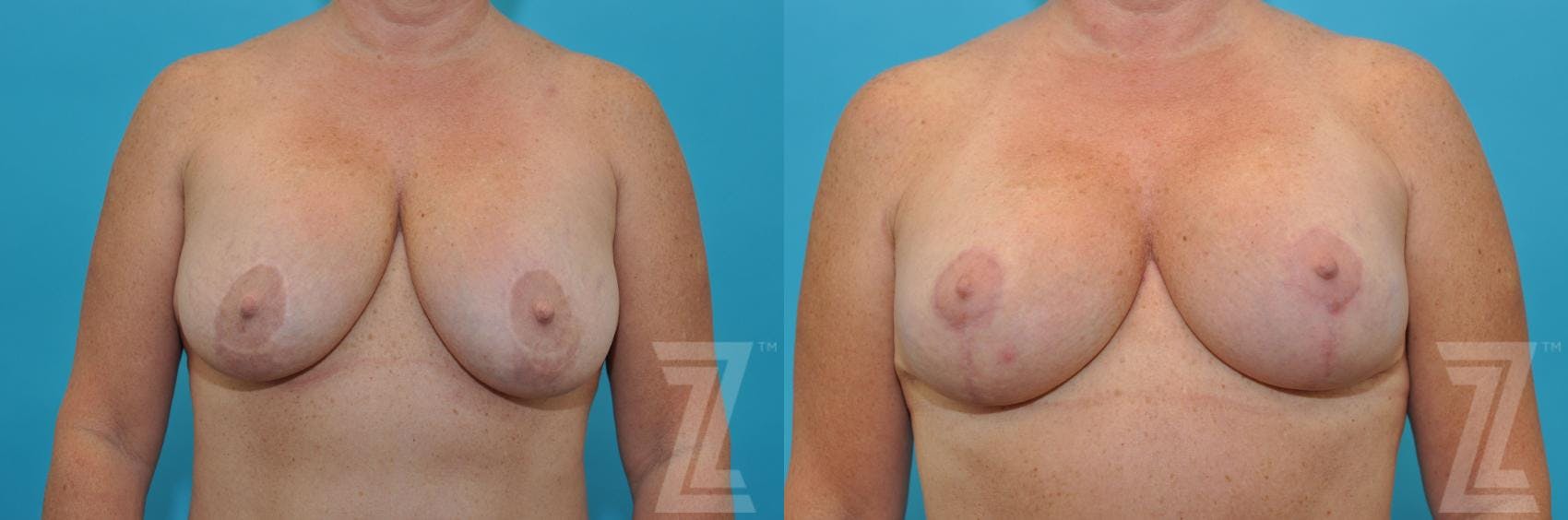 Breast Augmentation Revision Before & After Gallery - Patient 132886540 - Image 1