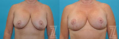 Austin Breast Augmentation Revision Before & After Gallery - Patient 132886540 - Image 1 - The Piazza Center