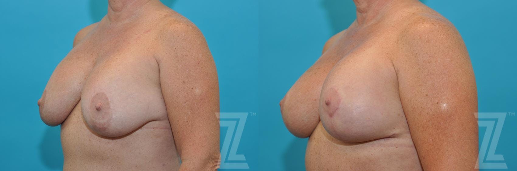 Breast Augmentation Revision Before & After Gallery - Patient 132886540 - Image 2