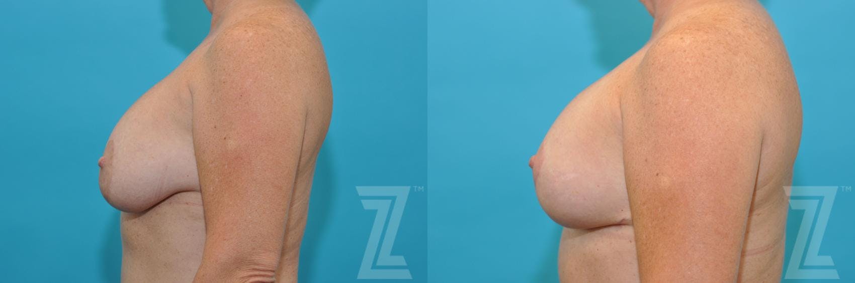 Breast Augmentation Revision Before & After Gallery - Patient 132886540 - Image 3