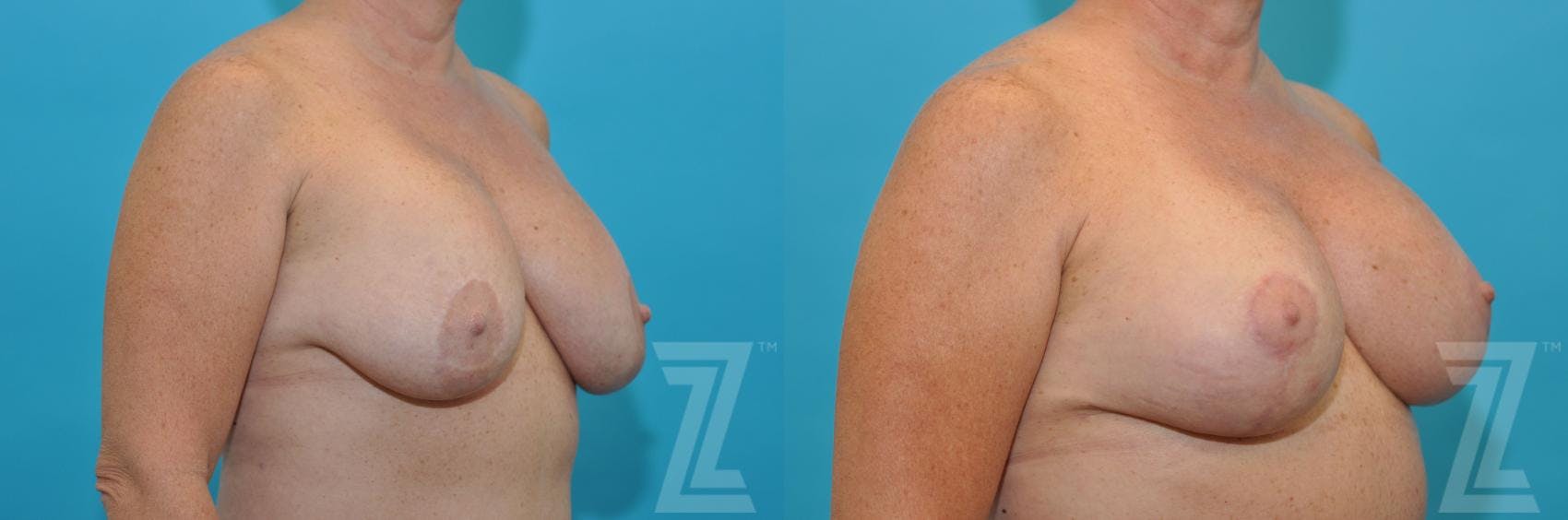 Breast Augmentation Revision Before & After Gallery - Patient 132886540 - Image 4
