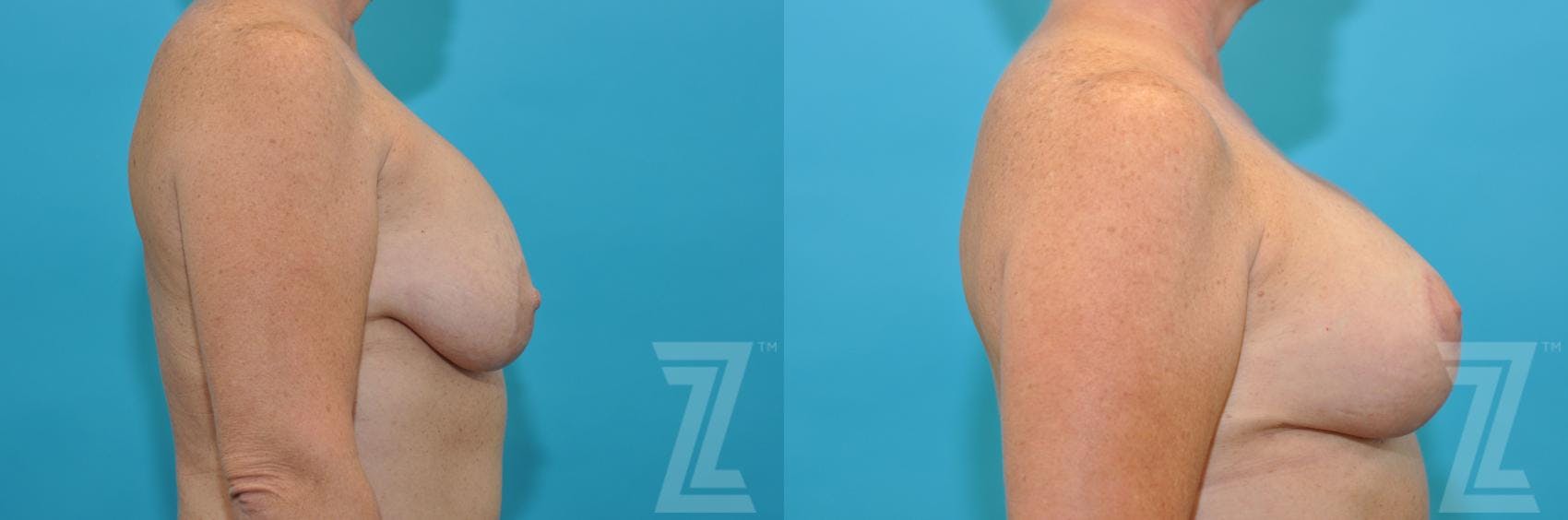 Breast Augmentation Revision Before & After Gallery - Patient 132886540 - Image 5