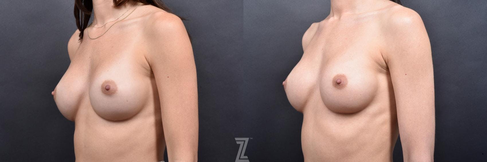 Breast Augmentation Revision Before & After Gallery - Patient 132886545 - Image 2
