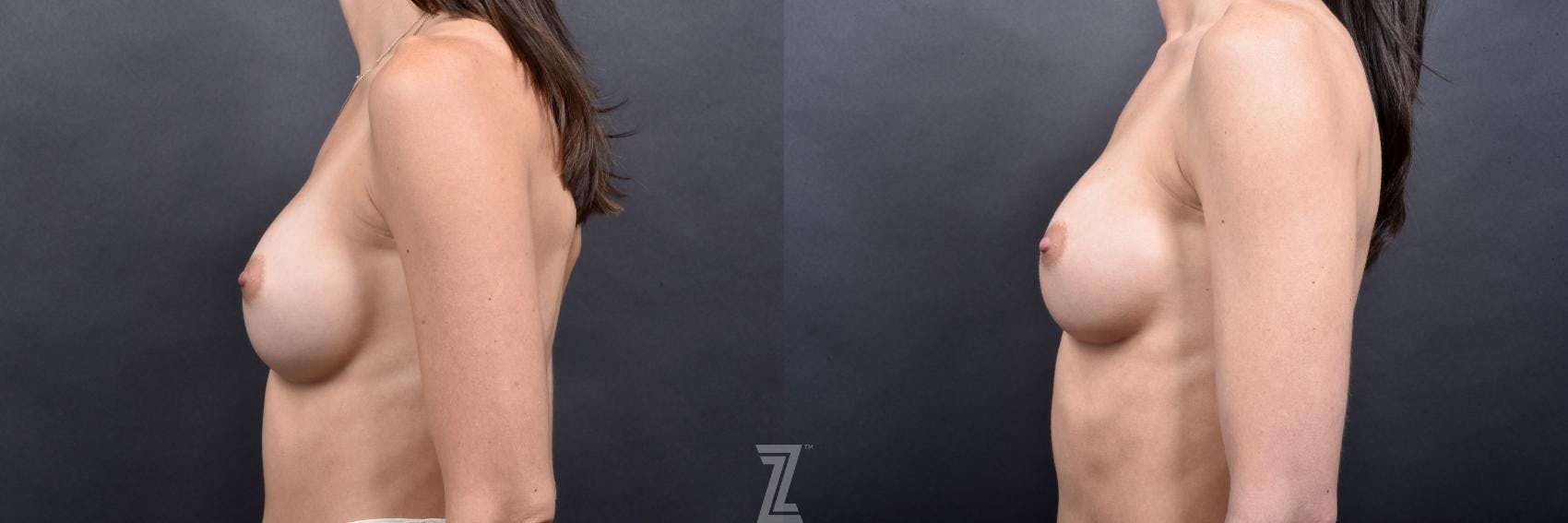 Breast Augmentation Revision Before & After Gallery - Patient 132886545 - Image 3