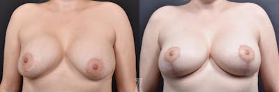 Austin Breast Augmentation Revision Before & After Gallery - Patient 132886548 - Image 1 - The Piazza Center
