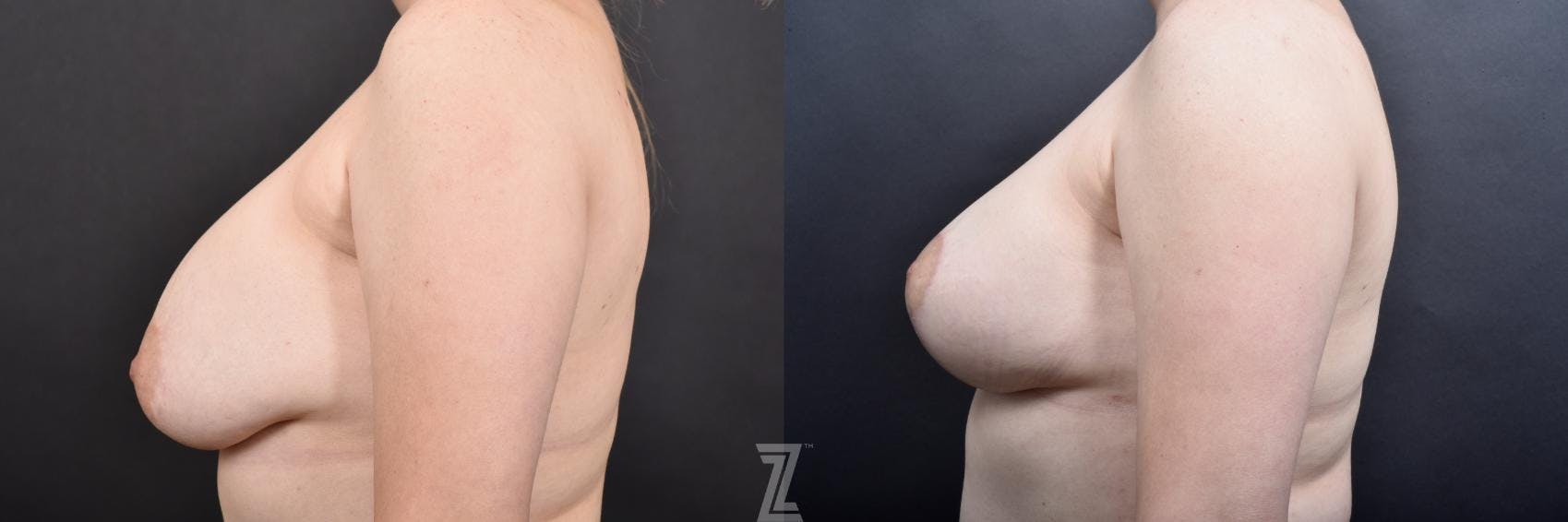 Breast Augmentation Revision Before & After Gallery - Patient 132886548 - Image 3