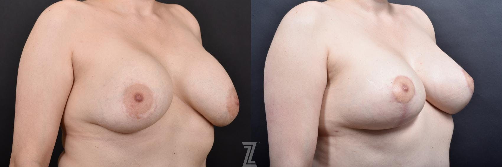 Breast Augmentation Revision Before & After Gallery - Patient 132886548 - Image 4