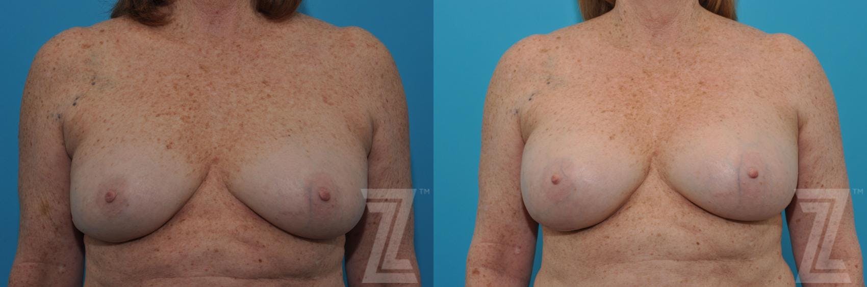 Breast Augmentation Revision Before & After Gallery - Patient 132886549 - Image 1