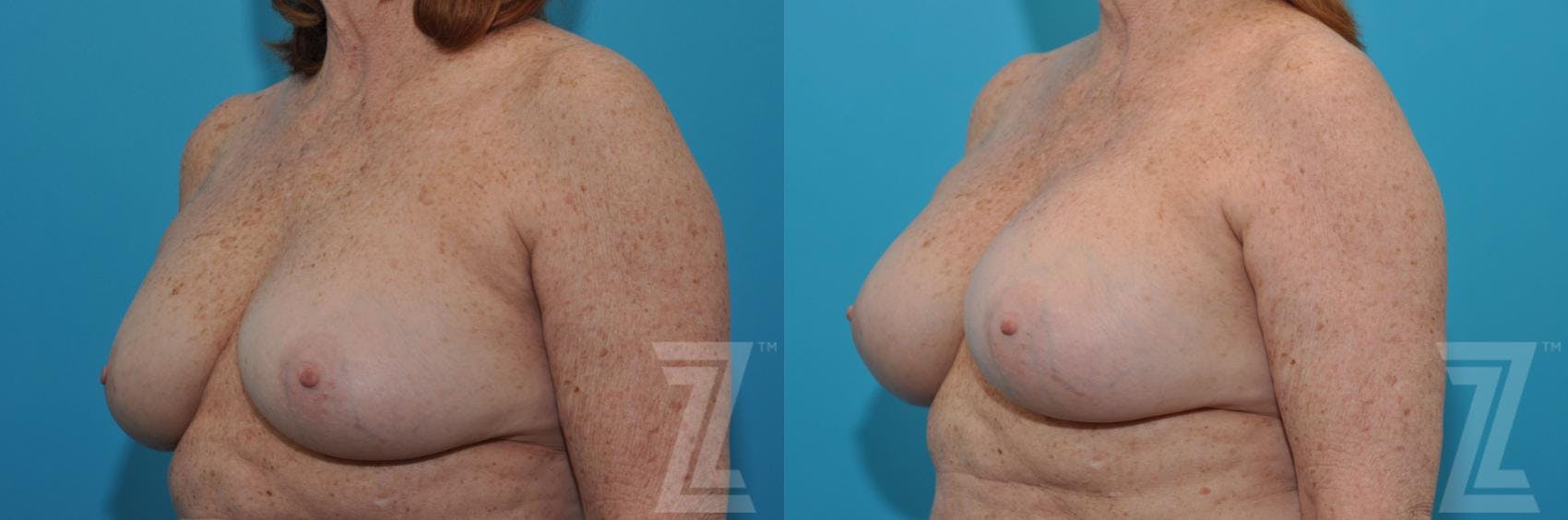 Breast Augmentation Revision Before & After Gallery - Patient 132886549 - Image 2