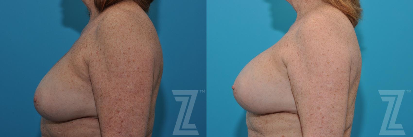 Breast Augmentation Revision Before & After Gallery - Patient 132886549 - Image 3