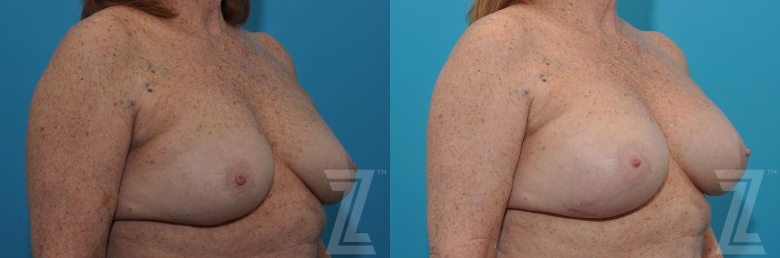 Austin Breast Augmentation Revision Before & After Gallery - Patient 132886549 - Image 4 - The Piazza Center