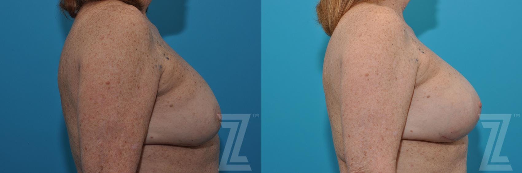 Breast Augmentation Revision Before & After Gallery - Patient 132886549 - Image 5