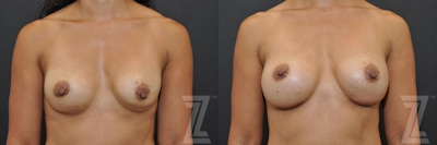 Breast Augmentation Revision Before & After Gallery - Patient 132886551 - Image 1