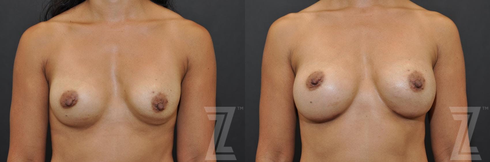Breast Augmentation Revision Before & After Gallery - Patient 132886551 - Image 1