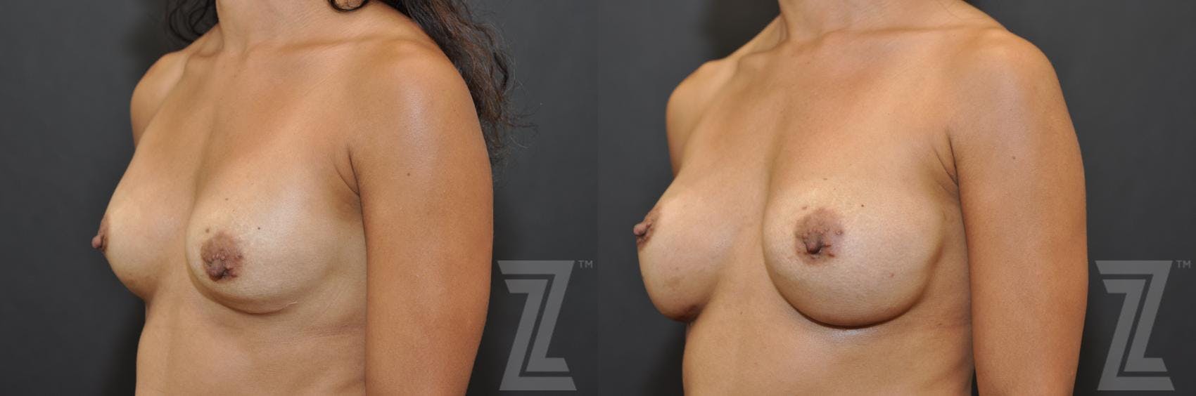 Breast Augmentation Revision Before & After Gallery - Patient 132886551 - Image 2