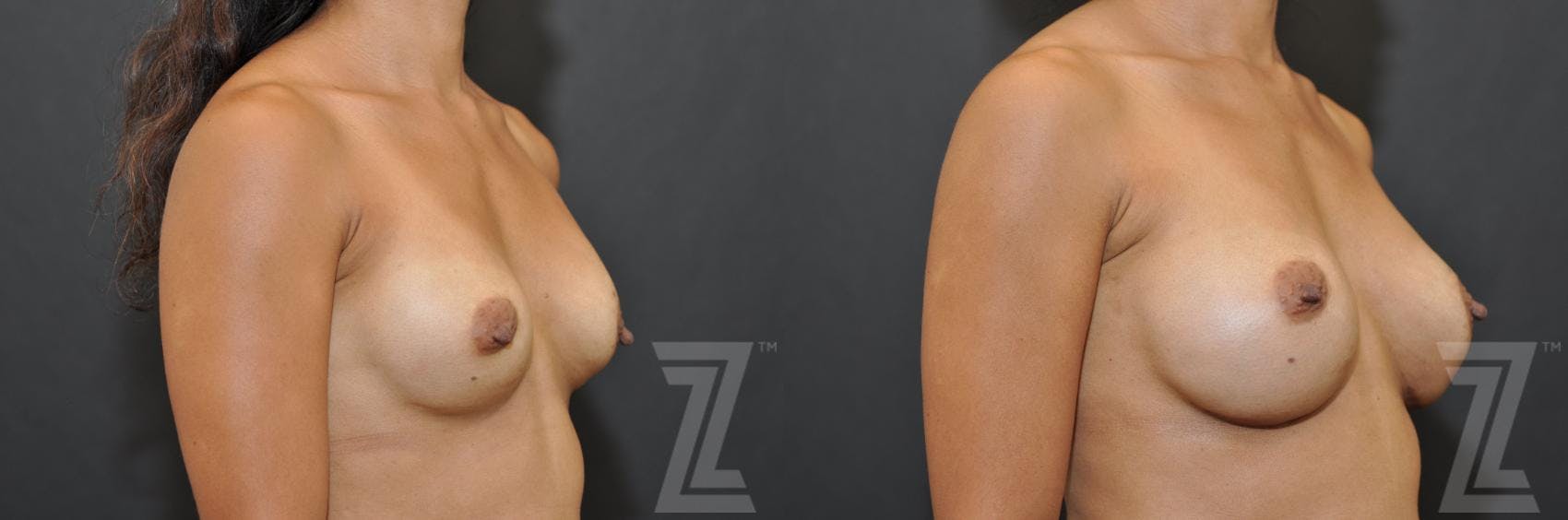 Breast Augmentation Revision Before & After Gallery - Patient 132886551 - Image 4