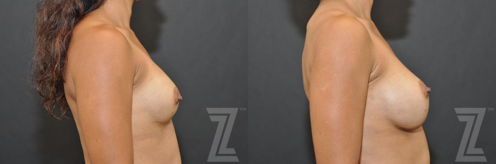 Breast Augmentation Revision Before & After Gallery - Patient 132886551 - Image 5