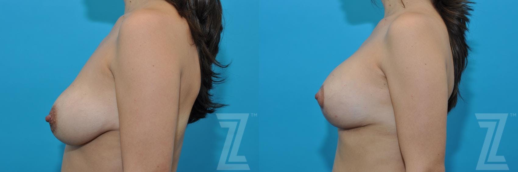 Breast Augmentation Revision Before & After Gallery - Patient 132886559 - Image 3