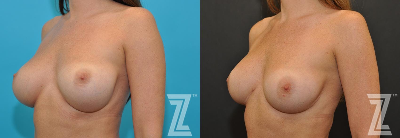 Breast Augmentation Revision Before & After Gallery - Patient 132886561 - Image 2