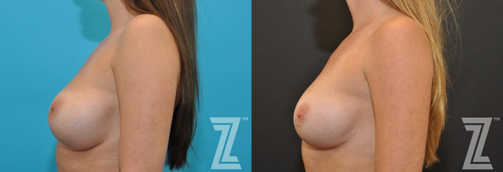 Breast Augmentation Revision Before & After Gallery - Patient 132886561 - Image 3