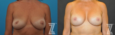 Breast Augmentation Revision Before & After Gallery - Patient 132886563 - Image 1