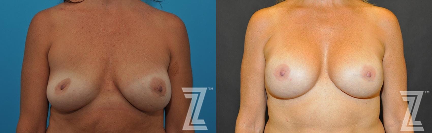 Breast Augmentation Revision Before & After Gallery - Patient 132886563 - Image 1