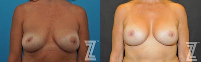 Austin Breast Augmentation Revision Before & After Gallery - Patient 132886563 - Image 1 - The Piazza Center