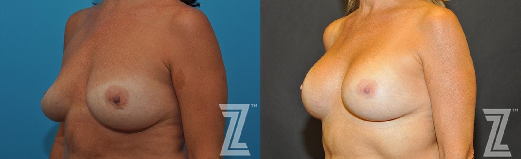 Breast Augmentation Revision Before & After Gallery - Patient 132886563 - Image 2