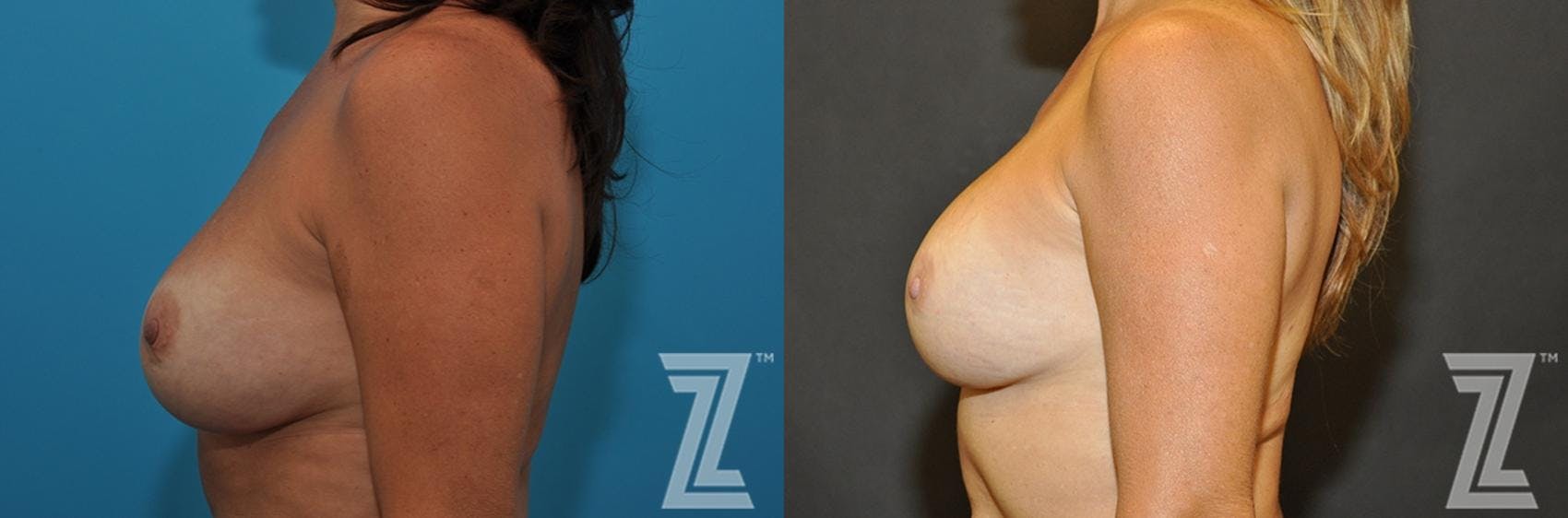 Breast Augmentation Revision Before & After Gallery - Patient 132886563 - Image 3