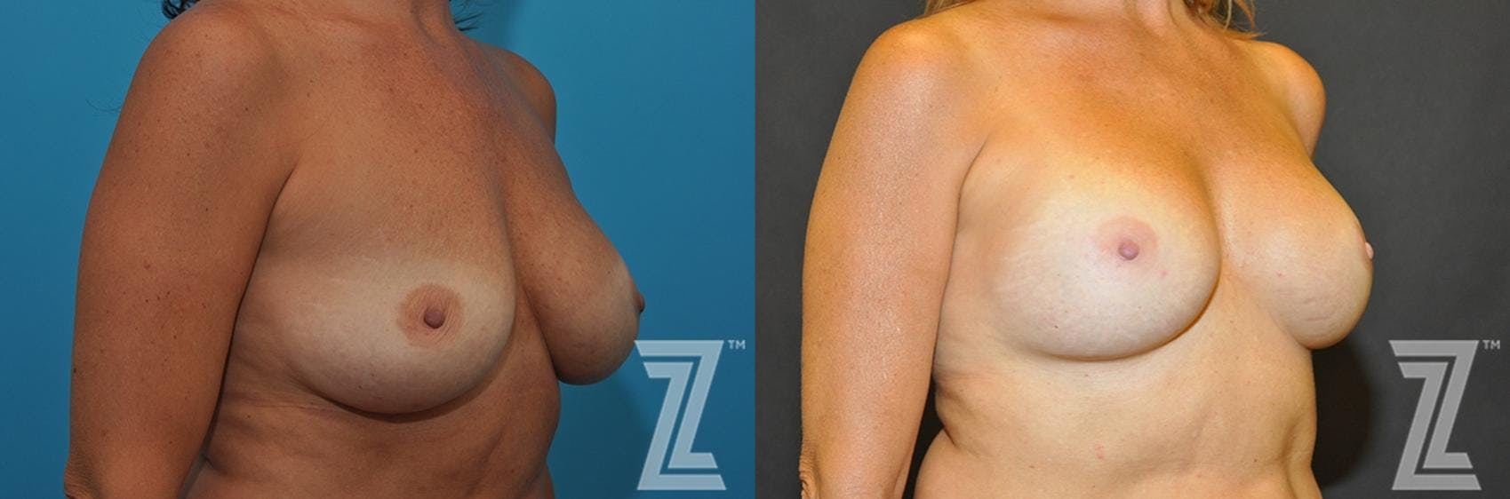 Breast Augmentation Revision Before & After Gallery - Patient 132886563 - Image 4