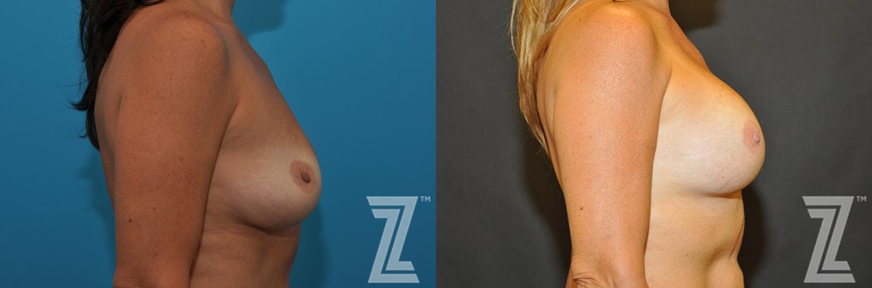 Breast Augmentation Revision Before & After Gallery - Patient 132886563 - Image 5