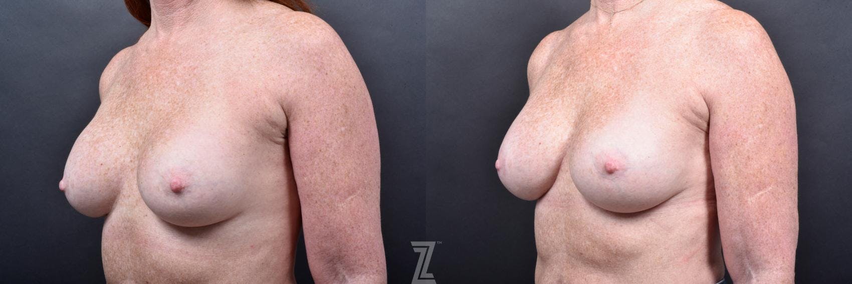 Breast Augmentation Revision Before & After Gallery - Patient 132886568 - Image 2