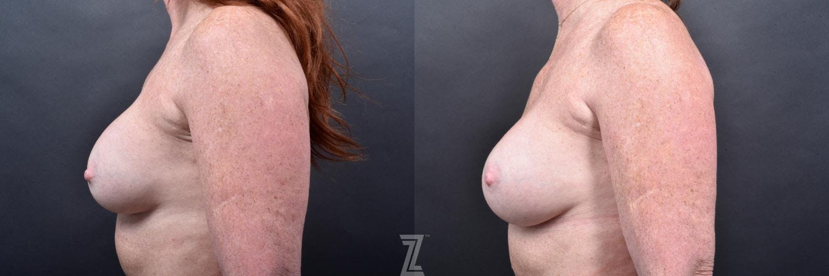 Breast Augmentation Revision Before & After Gallery - Patient 132886568 - Image 3