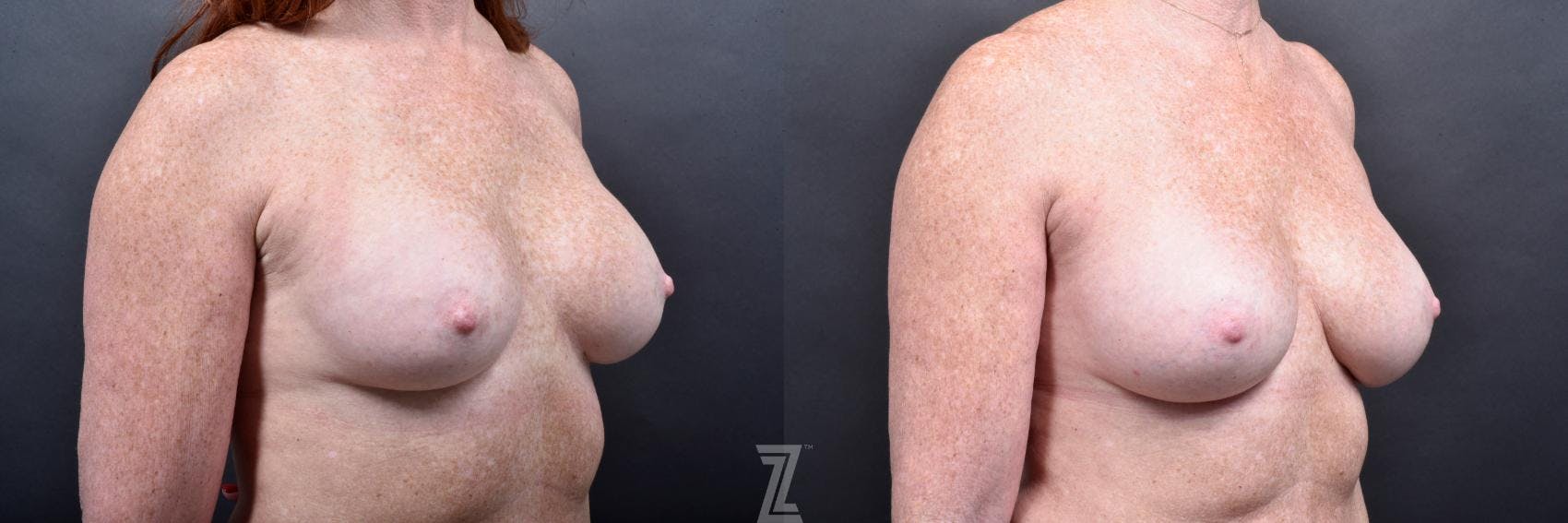 Breast Augmentation Revision Before & After Gallery - Patient 132886568 - Image 4