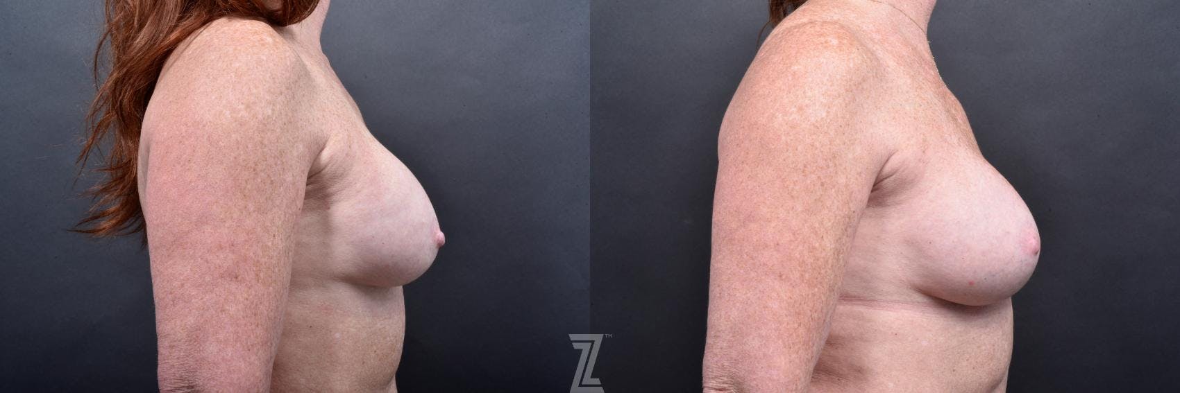 Breast Augmentation Revision Before & After Gallery - Patient 132886568 - Image 5