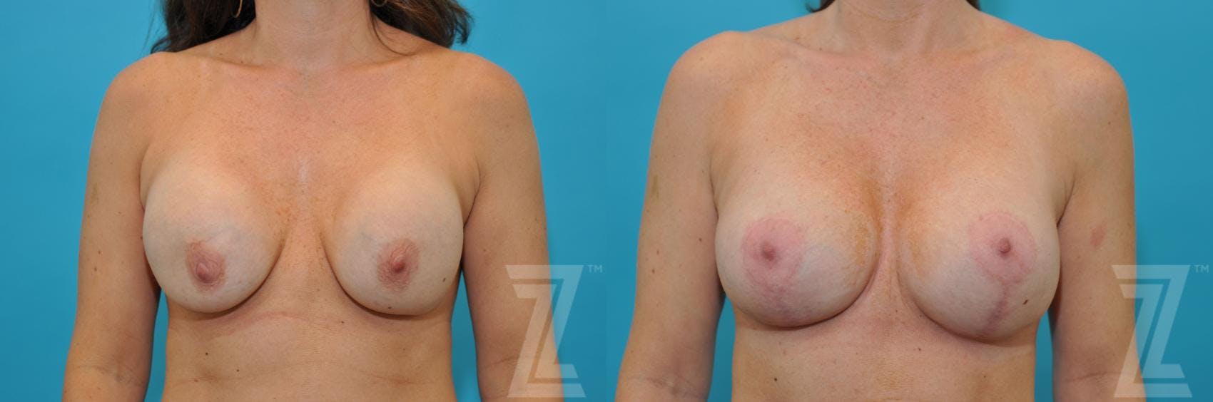 Breast Augmentation Revision Before & After Gallery - Patient 132886575 - Image 1