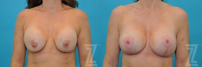 Breast Augmentation Revision Before & After Gallery - Patient 132886575 - Image 1