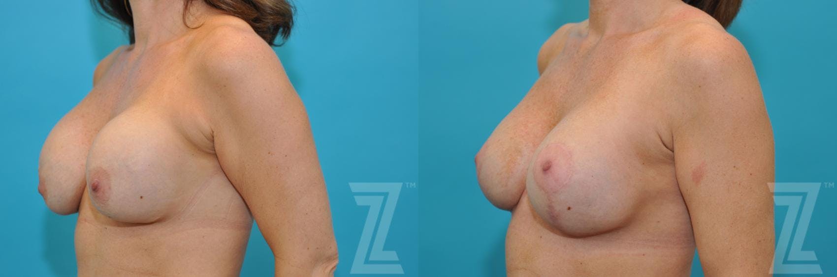 Breast Augmentation Revision Before & After Gallery - Patient 132886575 - Image 2