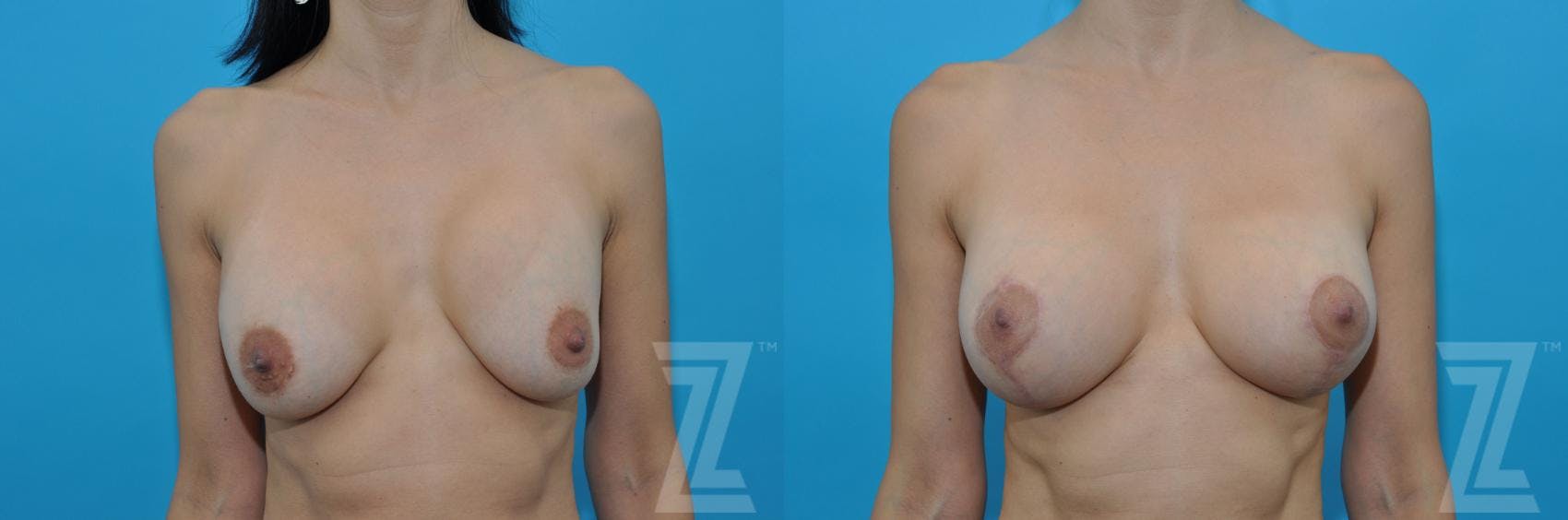 Breast Augmentation Revision Before & After Gallery - Patient 132886578 - Image 1