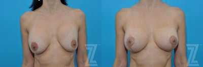 Austin Breast Augmentation Revision Before & After Gallery - Patient 132886578 - Image 1 - The Piazza Center