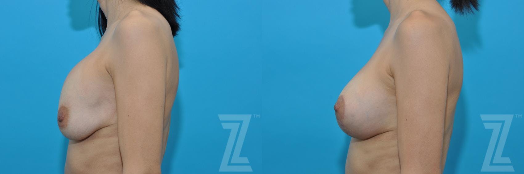 Breast Augmentation Revision Before & After Gallery - Patient 132886578 - Image 2