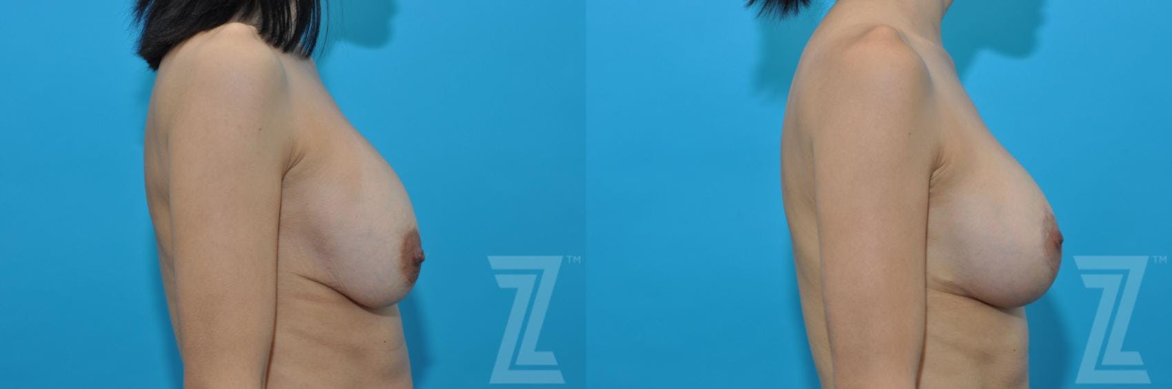 Breast Augmentation Revision Before & After Gallery - Patient 132886578 - Image 3
