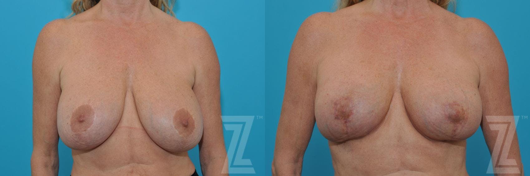 Breast Augmentation Revision Before & After Gallery - Patient 132886579 - Image 1