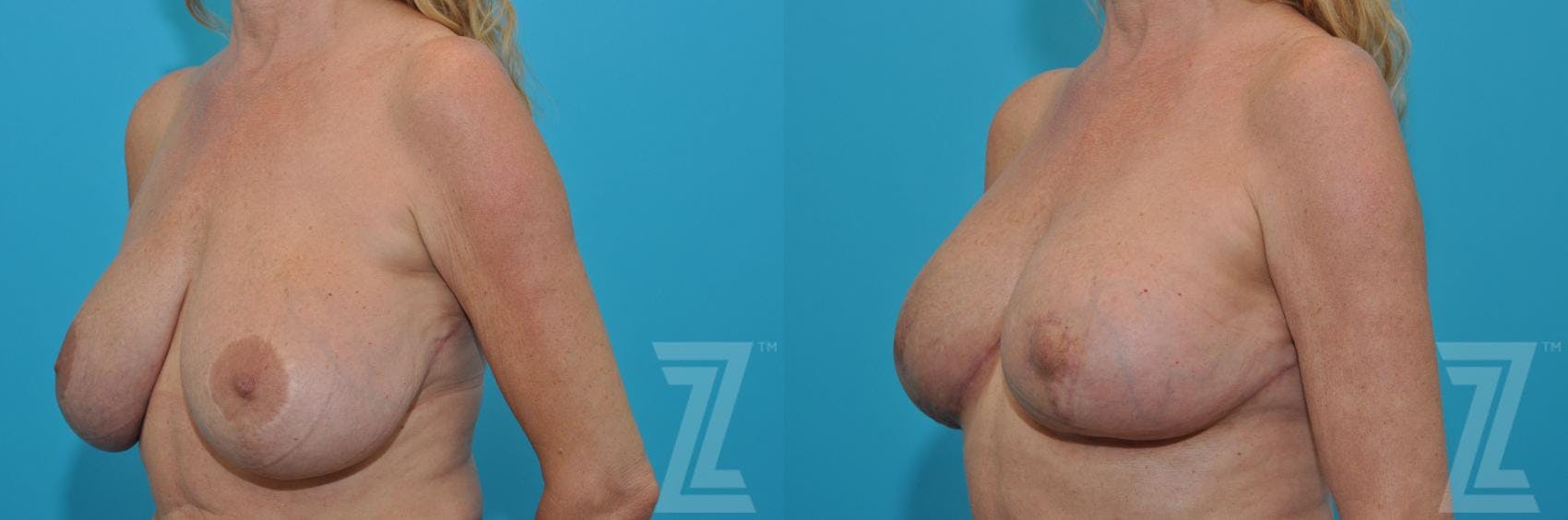 Breast Augmentation Revision Before & After Gallery - Patient 132886579 - Image 2