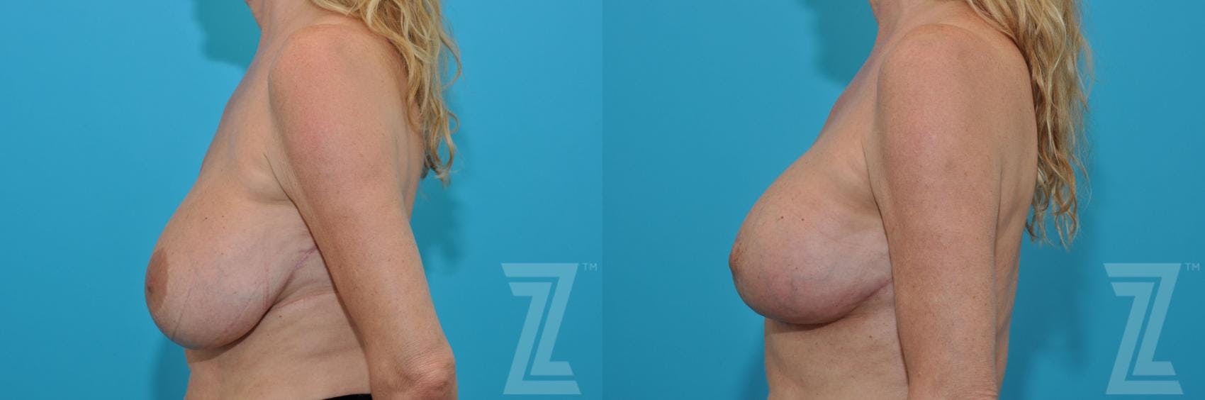 Breast Augmentation Revision Before & After Gallery - Patient 132886579 - Image 3