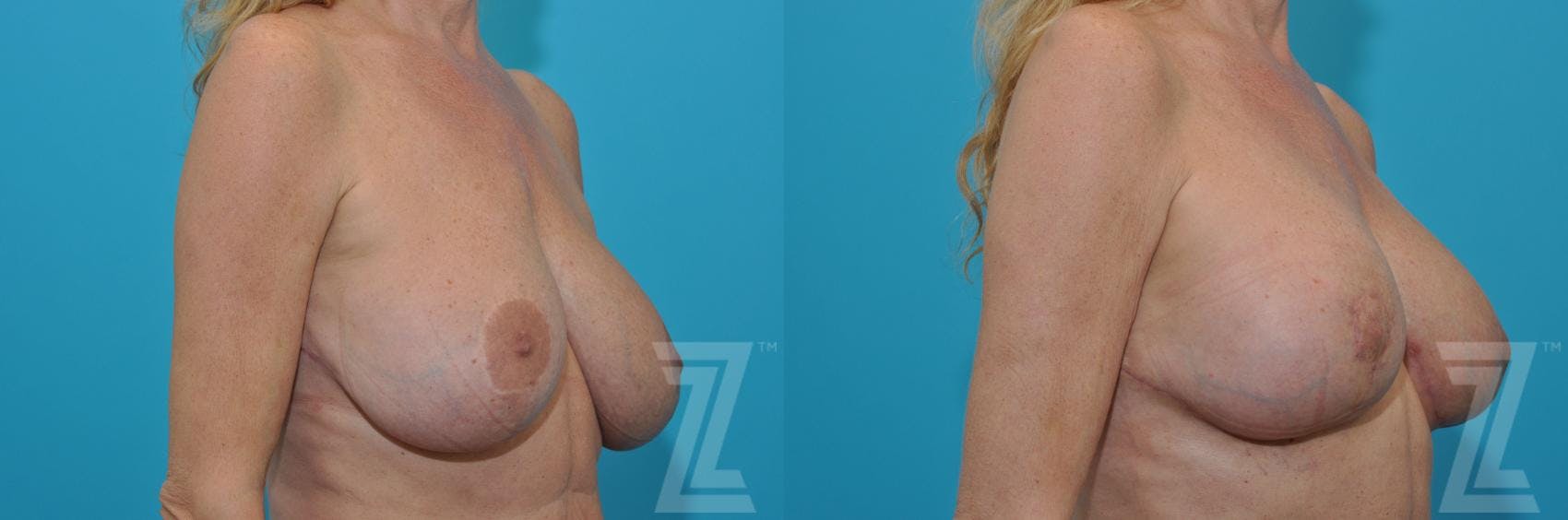 Breast Augmentation Revision Before & After Gallery - Patient 132886579 - Image 4