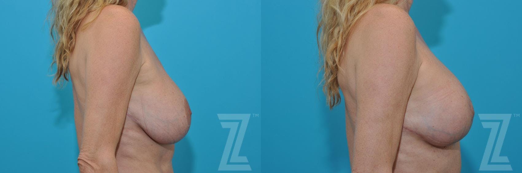 Breast Augmentation Revision Before & After Gallery - Patient 132886579 - Image 5