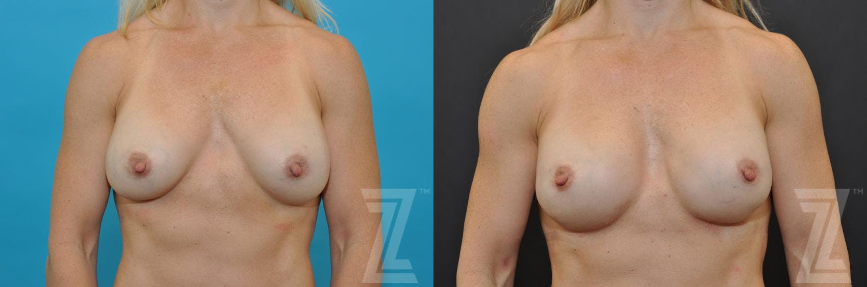 Breast Augmentation Revision Before & After Gallery - Patient 132886580 - Image 1