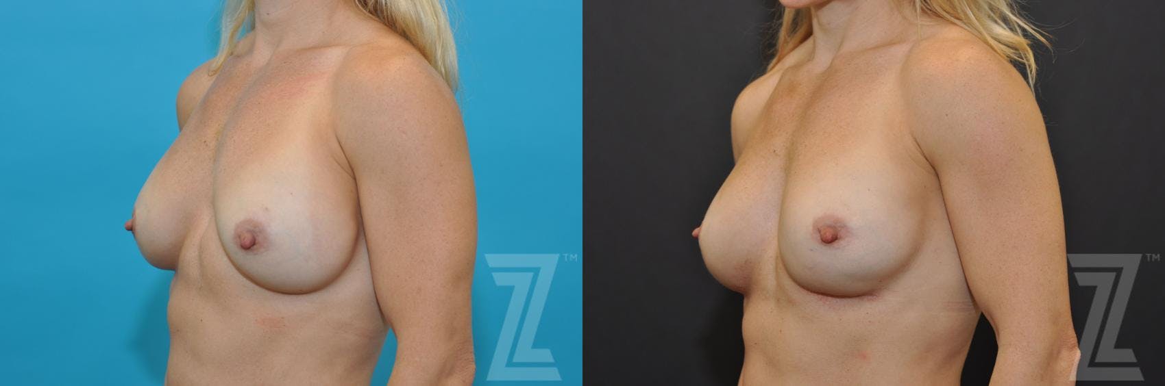 Breast Augmentation Revision Before & After Gallery - Patient 132886580 - Image 2