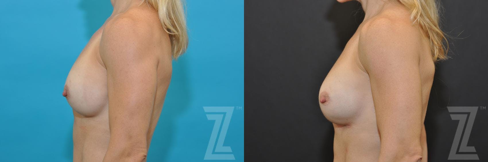 Breast Augmentation Revision Before & After Gallery - Patient 132886580 - Image 3